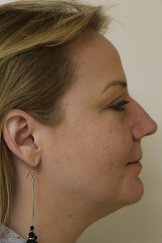 Vampire Facial 6 - After Treatment